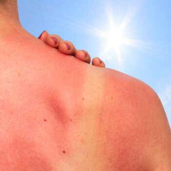 KOZMETIKA ZA ZAŠTITU OD SUNCA: Kako ohladiti izgorjelu kožu